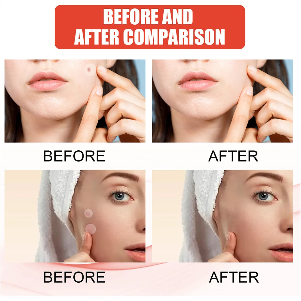 ClearCalm™ Pimple Patches ✨